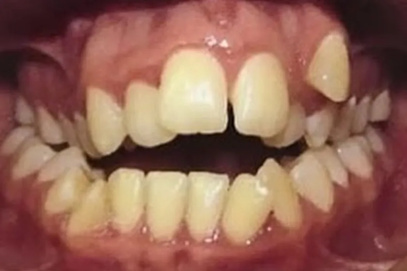 Antes: Aparelho ortodôntico, dentes apinhados e espaços