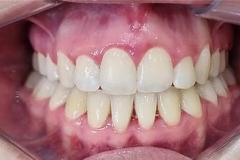 Depois: Aparelho ortodôntico, dentes apinhados e espaços