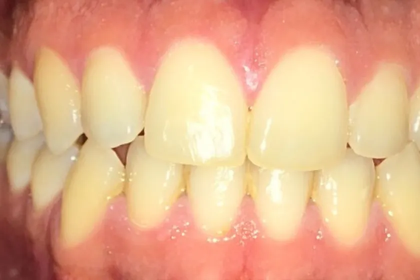 Antes: Clareamento dental, de consultório