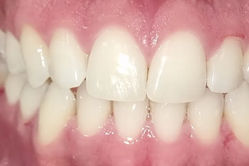 Depois: Clareamento dental, de consultório