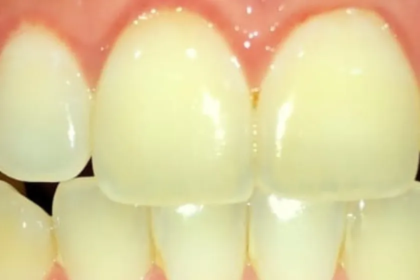 Antes: Clareamento dental, de consultório
