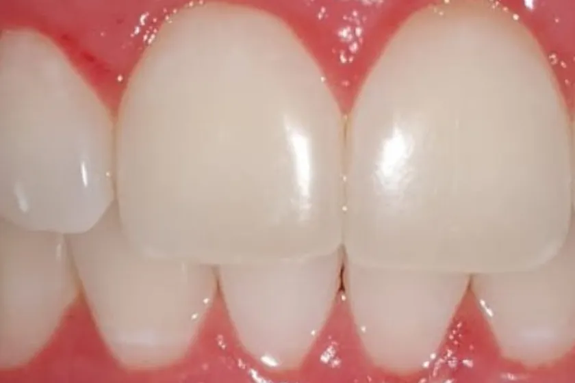 Depois: Clareamento dental, de consultório