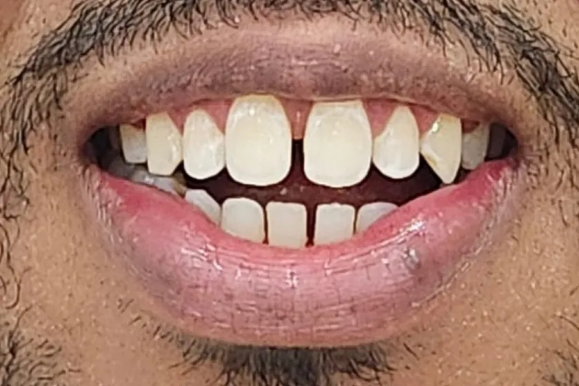 Antes: Facetas de resina, fechamento de espaços