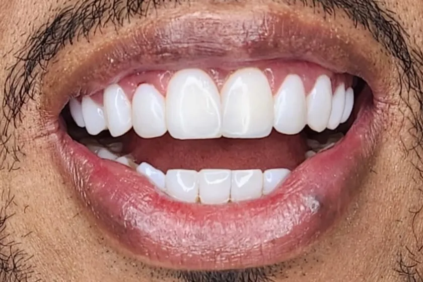 Depois: Facetas de resina, fechamento de espaços