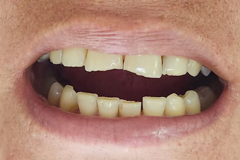 Antes: Facetas de resina, dentes desgastados