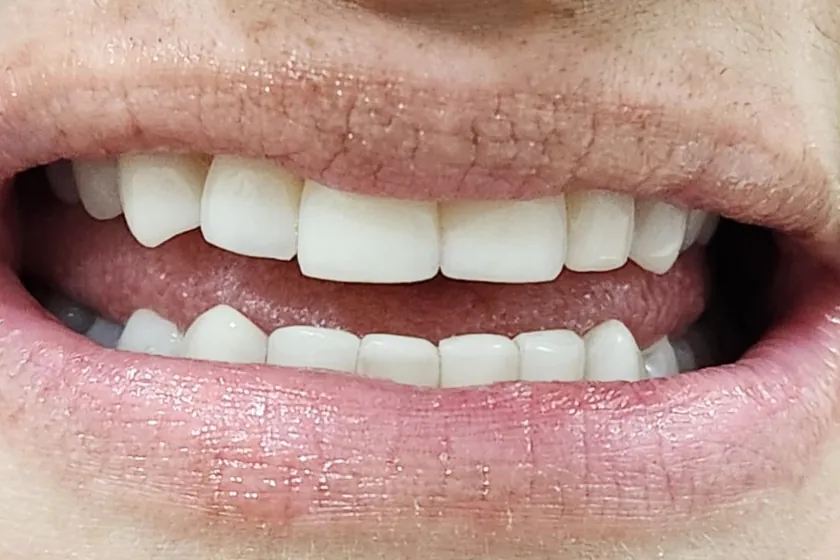 Depois: Facetas de resina, dentes desgastados