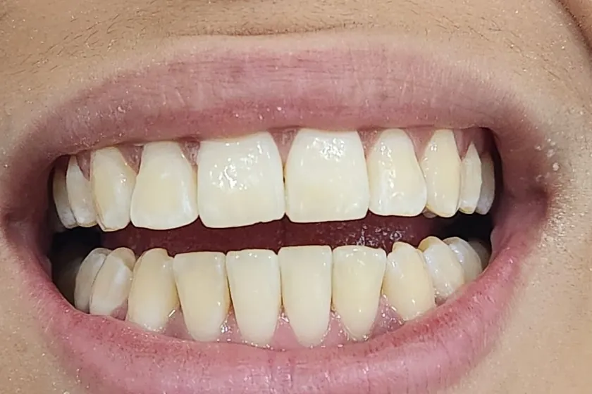 Antes: Facetas de resina, cor e formato