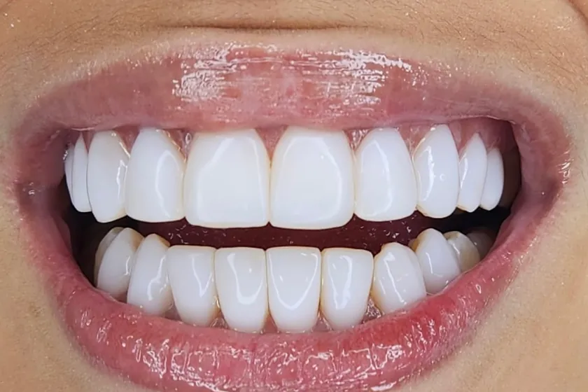 Depois: Facetas de resina, cor e formato