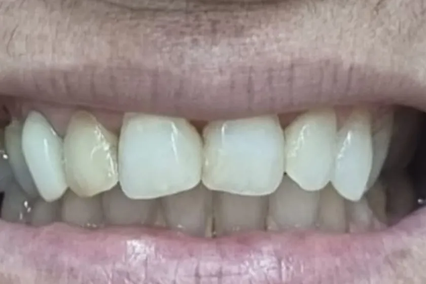 Antes: Facetas de resina, sorriso completo