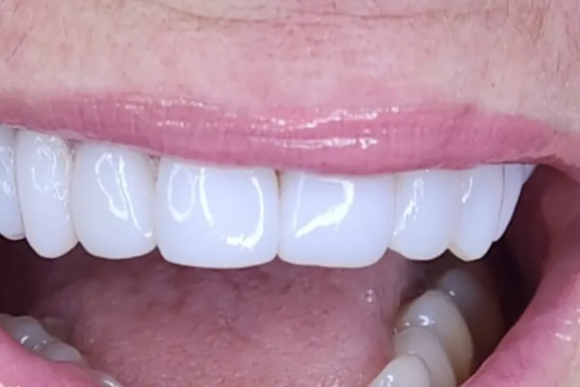 Depois: Facetas de resina, sorriso completo