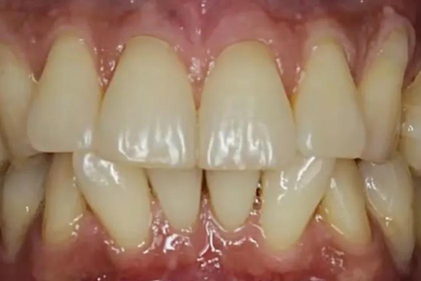 Antes: Aparelho invisível SouSmile, vista de frente