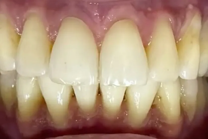 Depois: Aparelho invisível SouSmile, vista de frente