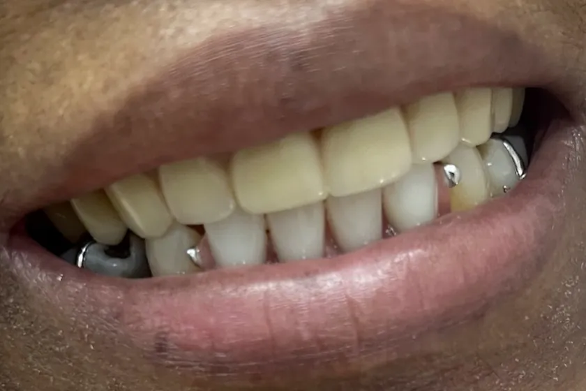 Antes: Prótese dentária, sorriso reabilitado