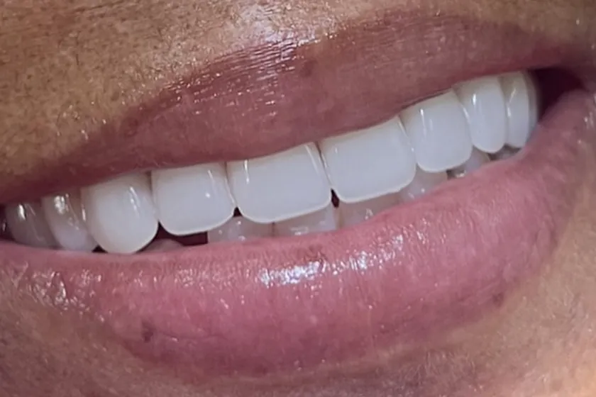 Depois: Prótese dentária, sorriso reabilitado
