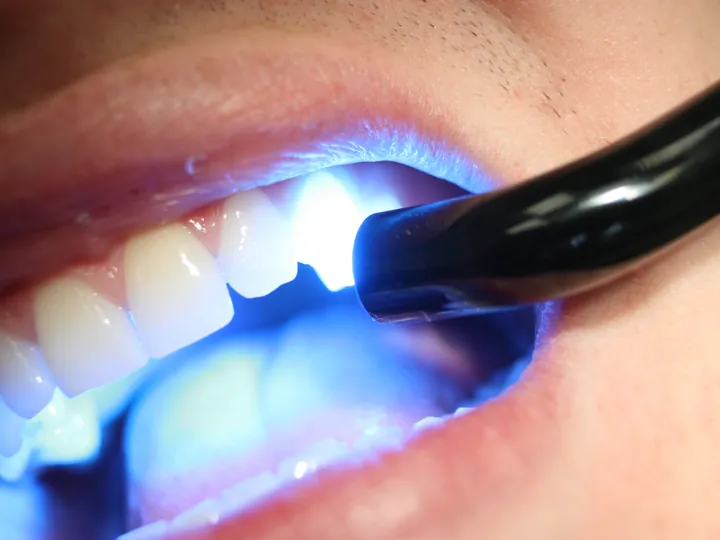 Luz azul endurecendo a resina aplicada na frente de um dente