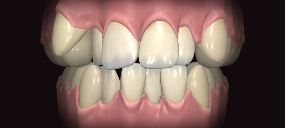 Simulação ilustrativa em 3D: dentes apinhados antes do aparelho invisível